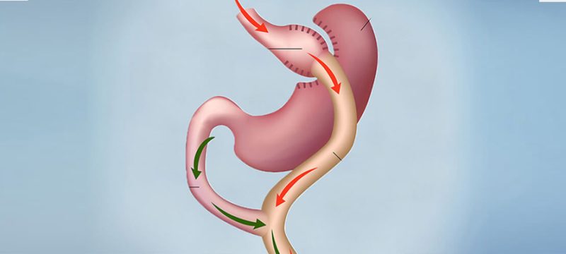 gastrik-bypass