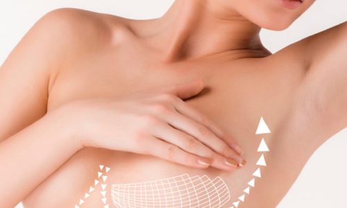 breast-lift