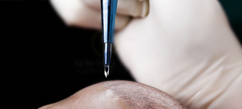 sapphire-hair-transplant