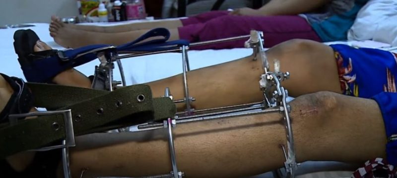 La chirurgie d'allongement