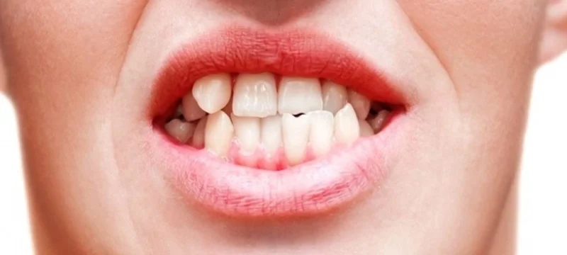 carpik-disler-icin-dis-kaplama