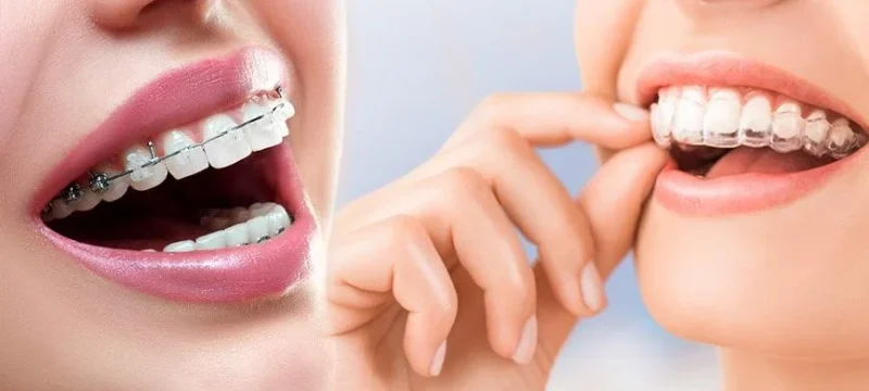 seffaf-plak-tedavisi