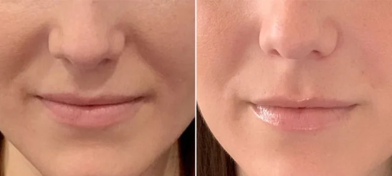 nazolabial-dolgu
