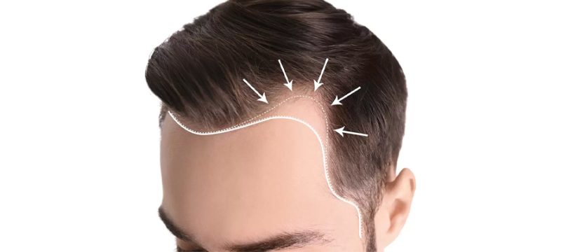 fue-hair-transplant
