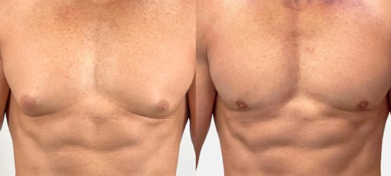 gynecomastia