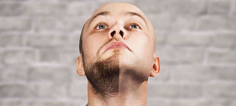 beard-transplant