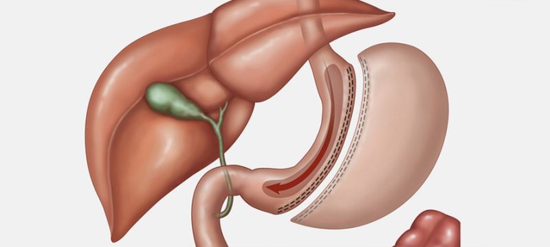 gastric-sleeve-surgery