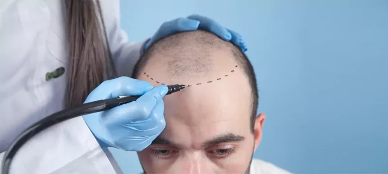 hair-transplant-turkey-cost